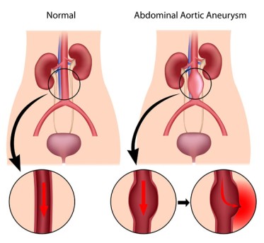 Aortic Aneurysm Repair by OrangeCountySurgeons